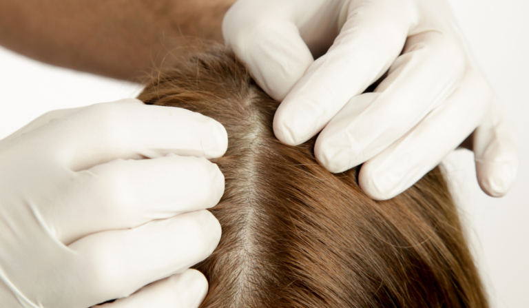 5 sfaturi pentru un scalp sănătos